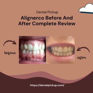 Alignerco-Before-And-After-Complete-Review