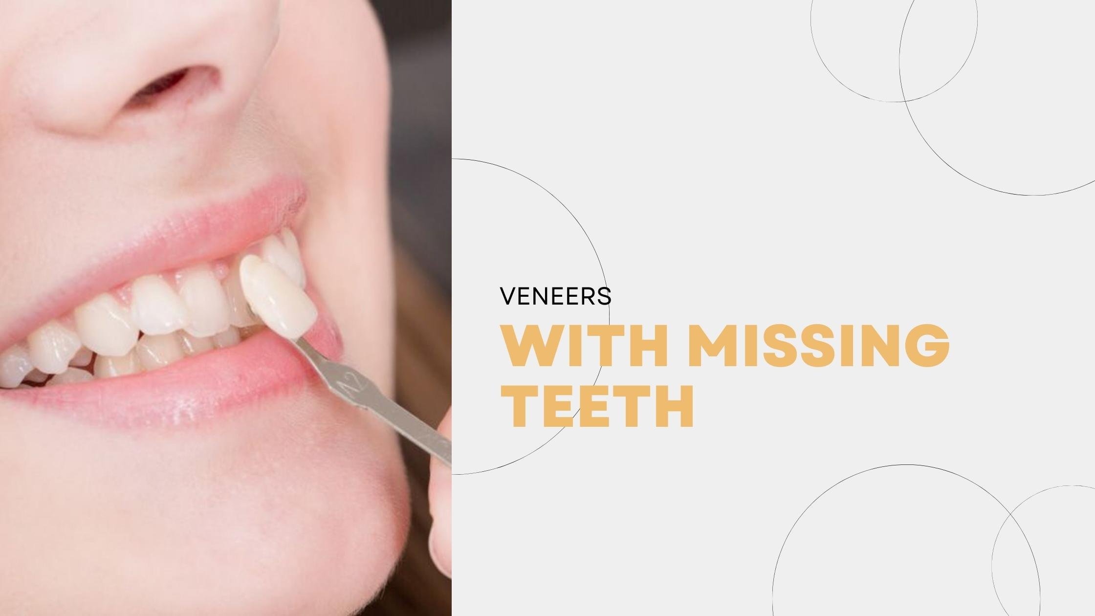 Veneers With Missing Teeth