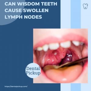 Can-Wisdom-Teeth-Cause-Swollen-Lymph-Nodes