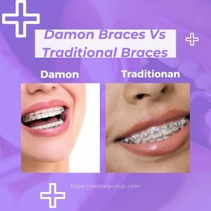 Damon-Braces-Vs-Traditional-Braces