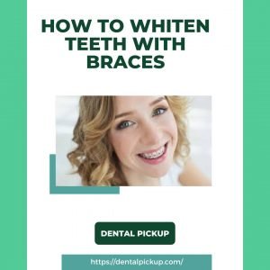 How-To-Whiten-Teeth-With-Braces