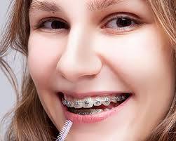 Right-Ways-To-Treat-White-Spots-from-Braces