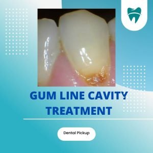 Gum-line-cavity-treatment