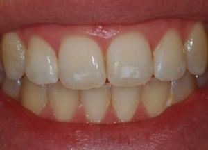  Prevention-Of-White-Spots-On-teeth