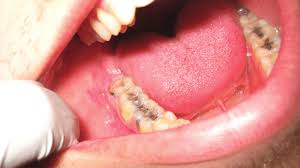 Third-molars-are-found-in-the-back-of-the-mouth