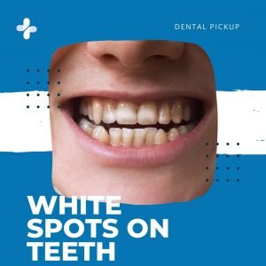 white-spots-on-teeth