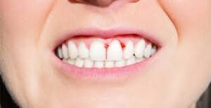 Causes-Of-Bleeding-Teeth-and-Gums