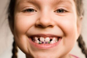 Minimum-Age-For-a-Child-To-Get-Braces