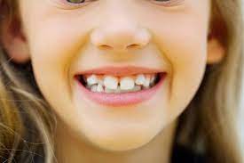 Signs-For-Kids-To-Get-Braces