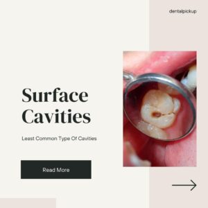 Surface Cavities: Least Common Type Of Cavities