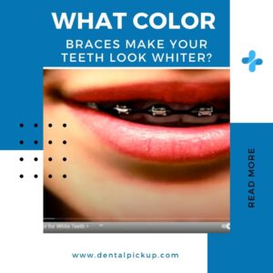 What Color Braces Make Your Teeth Look Whiter?