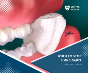 When To Stop Using Gauze After Tooth Extraction