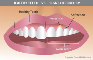 What Are The Other Side Effects Of Bruxism?