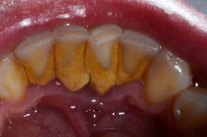 Orange Plaque on Teeth 