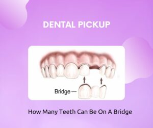 How-Many-Teeth-Can-Be-On-A-Bridge