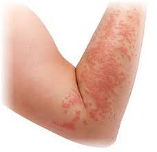 How-To-Treat-Contact-Dermatitis