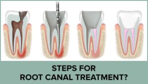 Root-Canal-Procedure